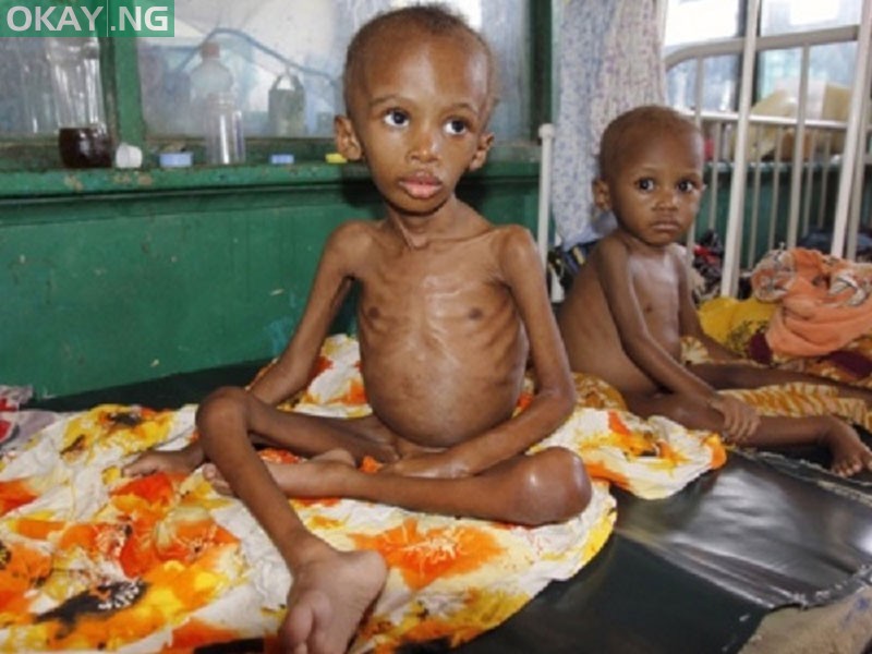 File: Photo of Malnourished children